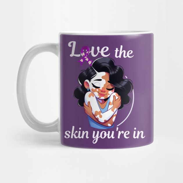 Love The Skin You're In Vitiligo Awareness and Acceptance by Mind Your Tee